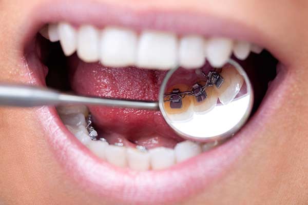 Lingual-Braces