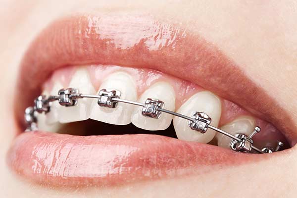 Self-Ligating-Brackets